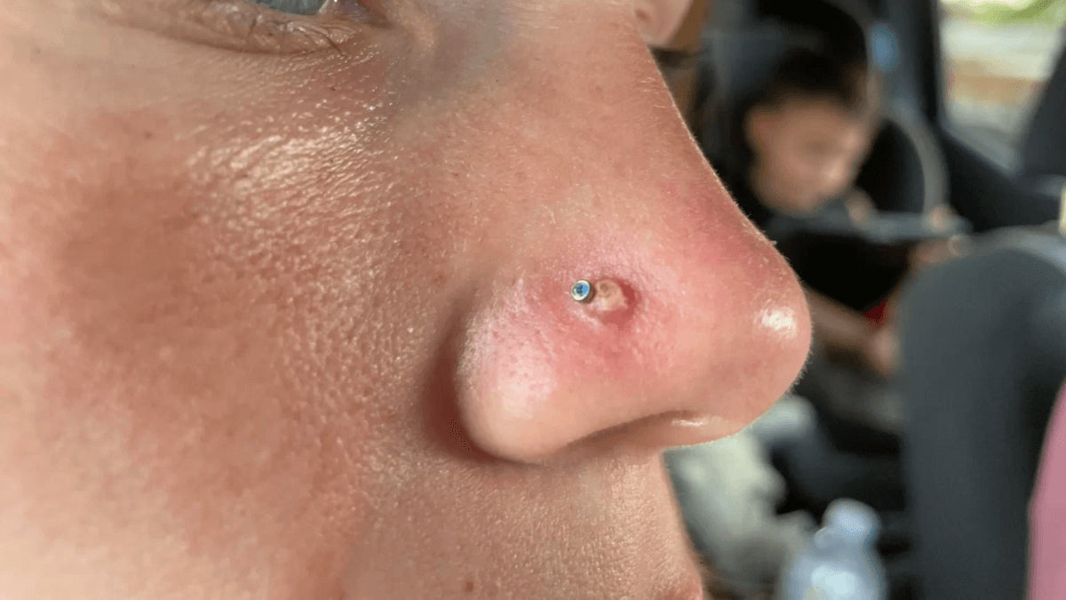 Granuloma: Bumps on Your Piercing